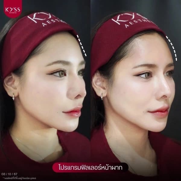 รีวิวโปรแกรมฉีดฟิลเลอร์หน้าผาก เติมเต็มรอยบุ๋ม ปรับมิติใบหน้า ที่ KYSS Clinic