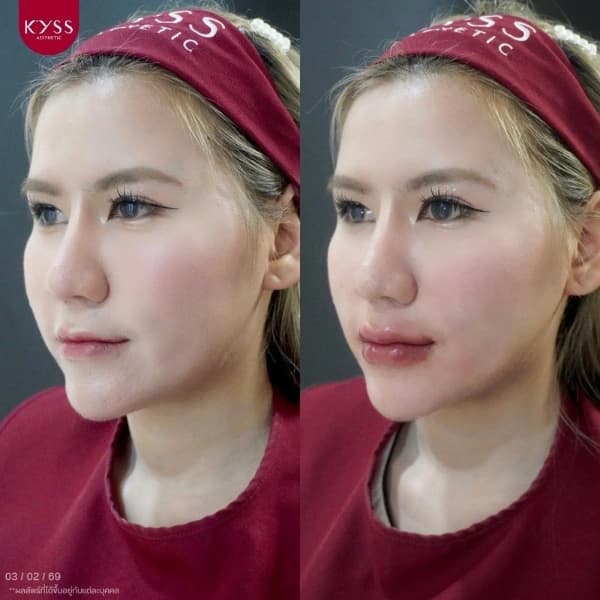 รีวิวโปรแกรมฉีดฟิลเลอร์ปากทรงสาวหวาน ยกมุมปาก เติมร่องปากตื้น ที่ KYSS Clinic