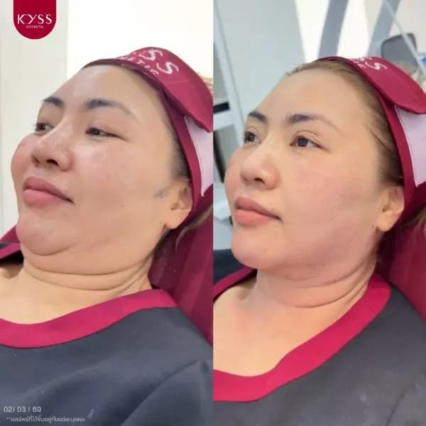 รีวิวทำโปรแกรม Morpheus 8 ยกกระชับหน้า ดูแลการหย่อนคล้อย ที่ KYSS Clinic