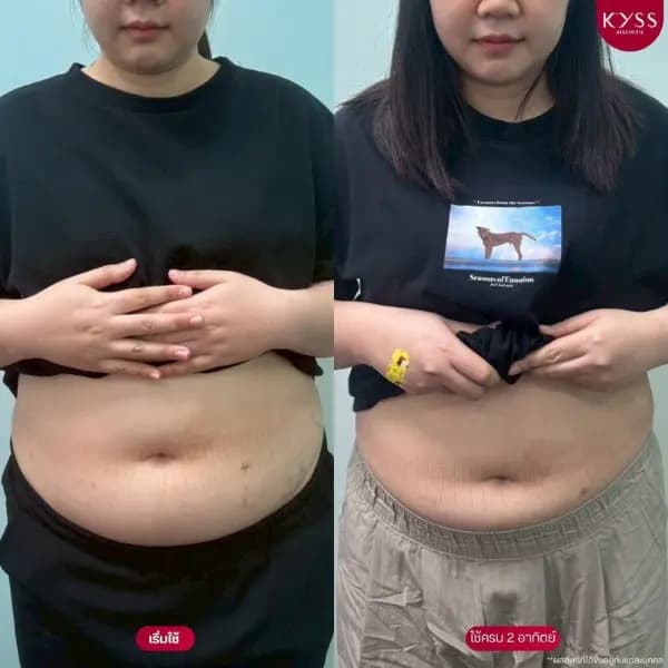 รีวิวผลลัพธ์โปรแกรมดูแลรูปร่าง ภายใต้การดูแลของแพทย์ KYSS Clinic