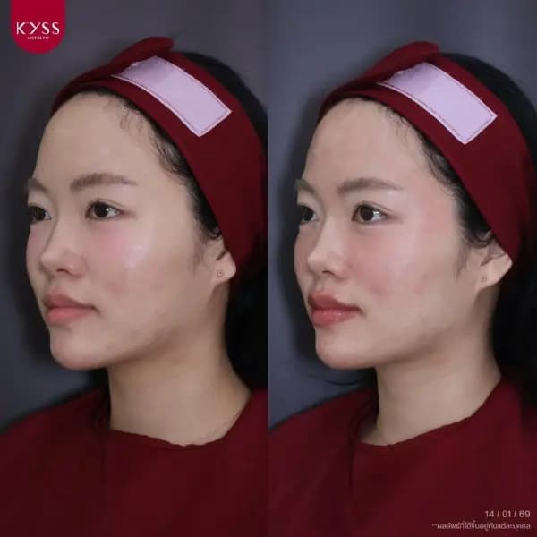 รีวิวทำโปรแกรม Pico Laser ดูแลรอยดำ รอยสิว หน้าแลดูกระจ่างใส ที่ KYSS Clinic