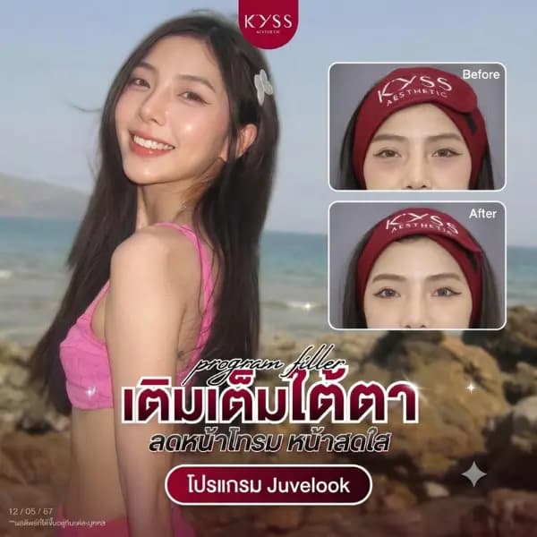 รีวิวโปรแกรมฉีดฟิลเลอร์ใต้ตา ดูแลใต้ตาคล้ำ เบ้าตาลึก ร่องน้ำตา ที่ KYSS Clinic