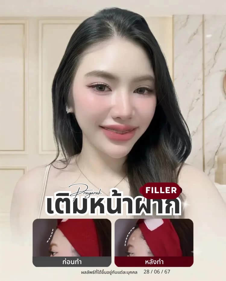 ฉีดฟิลเลอร์คาง ฟิลเลอร์หน้าผาก บางจาก สุขุมวิท KYSS Clinic