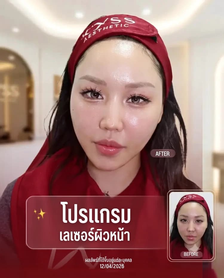เลเซอร์หน้าใส Pico Laser รักษาสิว บางจาก สุขุมวิท KYSS Clinic