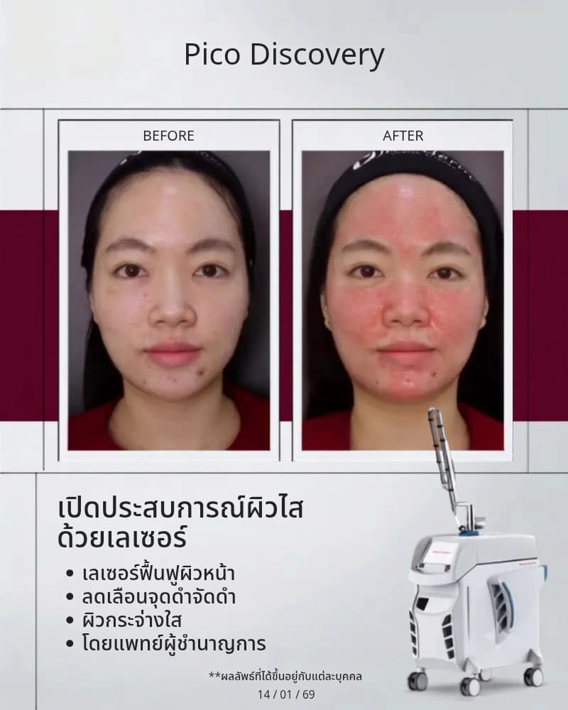 รีวิวรักษาหลุมสิว กระชับรูขุมขน Pico Fractional บางจาก สุขุมวิท