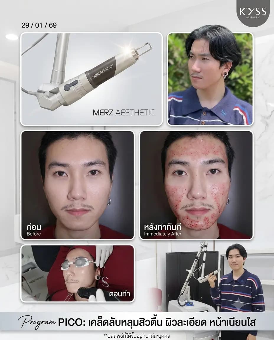 รีวิวรักษารอยสิวด้วย Pico Laser เลเซอร์หน้าใส บางจาก สุขุมวิท