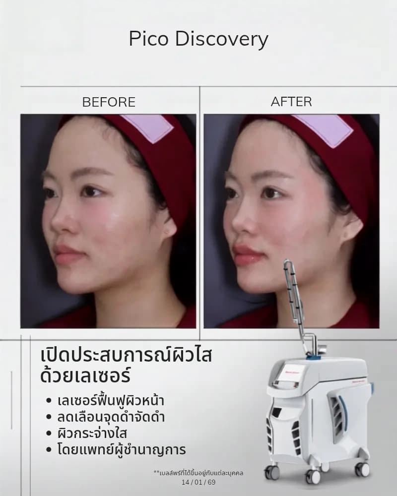รีวิวรักษาฝ้า กระ จุดด่างดำด้วย Pico Laser บางจาก สุขุมวิท