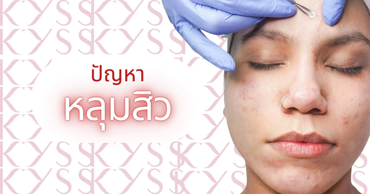 การรักษารอยสิวและหลุมสิวด้วยเทคโนโลยีเลเซอร์ที่ KYSS Clinic สาขาศรีราชา