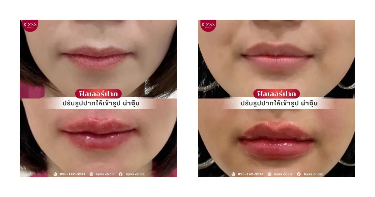 วิเคราะห์ปัญหาปาก 8 รูปแบบด้วยโปรแกรมฟิลเลอร์ปาก | KYSS Clinic ในบางจาก คลินิกความงามอันดับต้นๆ ต้อง KYSS Clinic