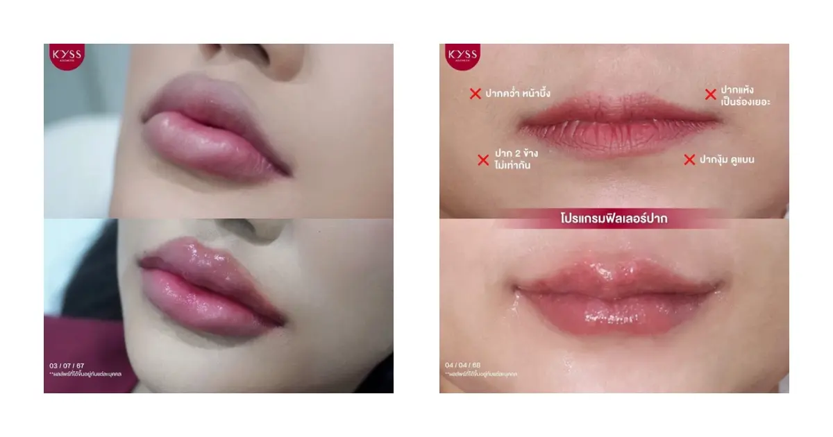 วิเคราะห์ปัญหาปาก 8 รูปแบบด้วยโปรแกรมฟิลเลอร์ปาก | KYSS Clinic ดูแลโดยแพทย์ชำนาญการ สาขาพัทยา | KYSS Clinic