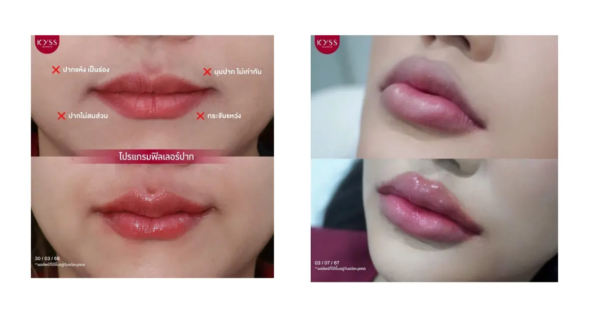 บริการ วิเคราะห์ปัญหาปาก 8 รูปแบบด้วยโปรแกรมฟิลเลอร์ปาก | KYSS Clinic ที่ KYSS Clinic สาขาศรีราชา ปลอดภัยมาตรฐานสูง