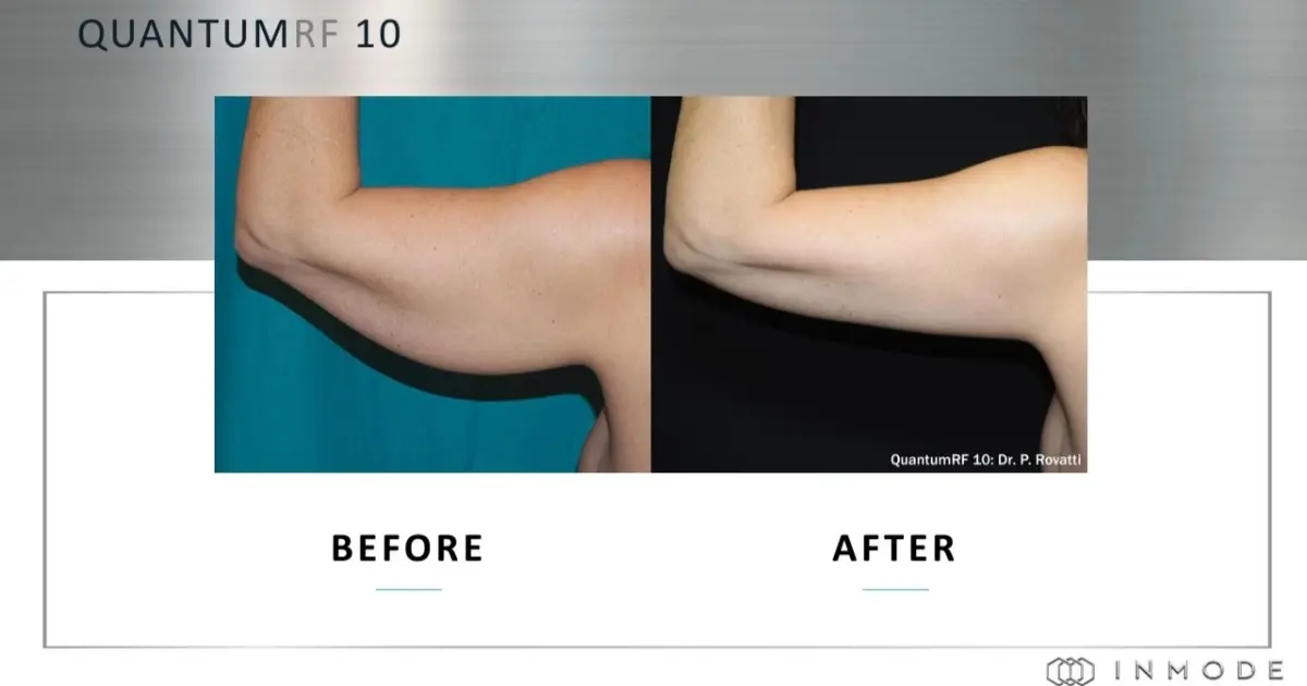 โปรแกรม Ignite RF เทคโนโลยีกระชับผิวและสัดส่วนระดับลึกที่ KYSS Clinic สาขาบางจาก
