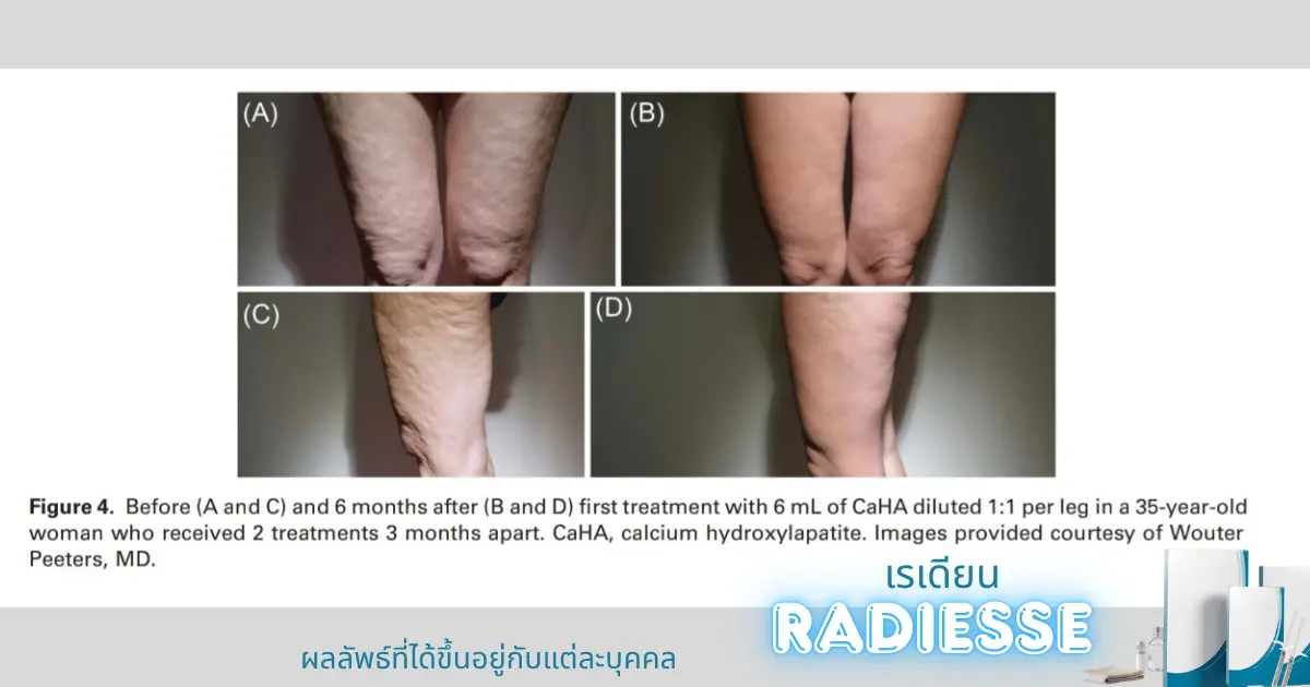 การทำหัตถการปรับรูปหน้าด้วยโปรแกรม CaHA ที่ KYSS Clinic สาขาศรีราชา